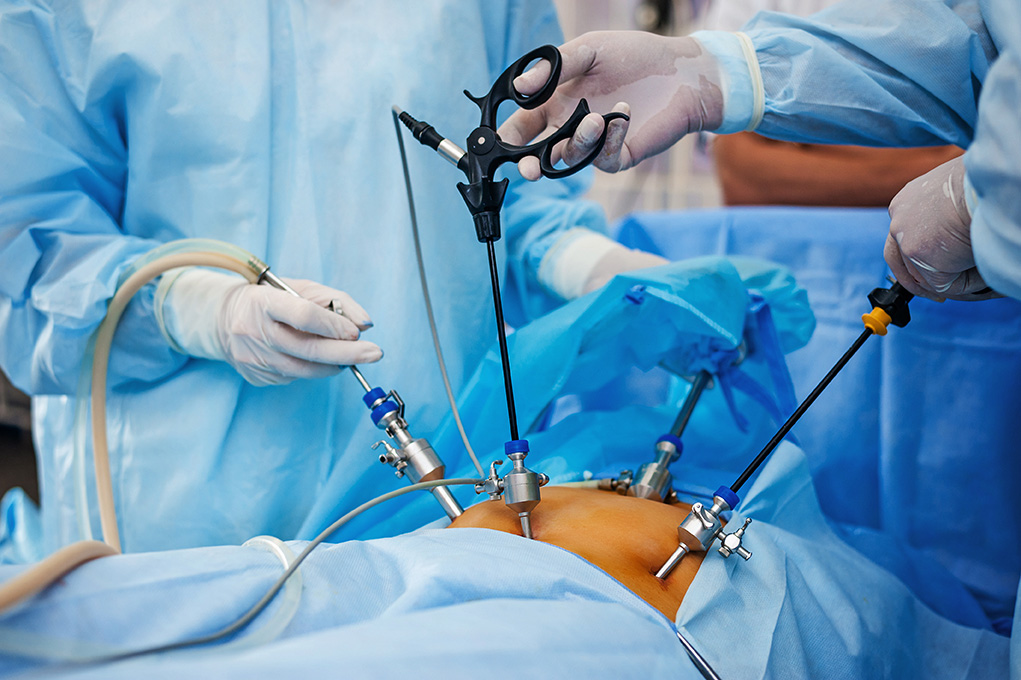 Advanced Laparoscopy for fertility